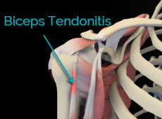 Biceps Tendonitis