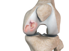 Chondral (Articular Cartilage Defects)